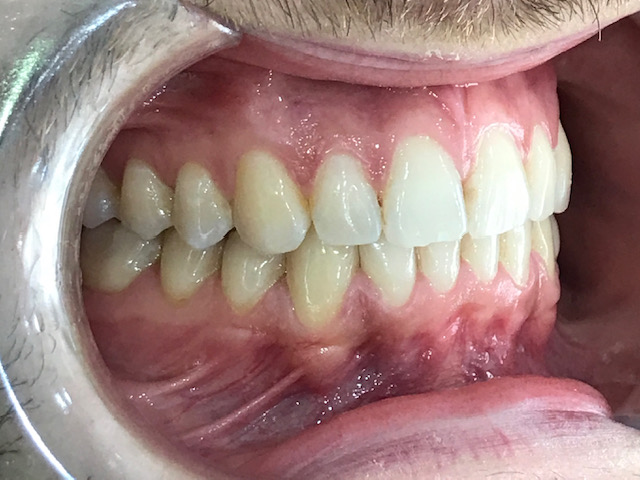 alineamiento-dental-con-orotodoncia-invisible-varon-joven-resultado