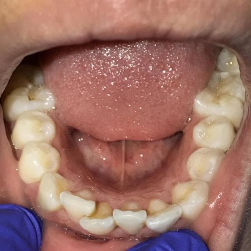 inicio-tratamiento-ortodoncia-transparente-invisalign