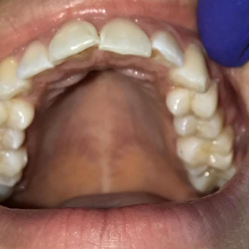 inicio-tratamiento-ortodoncia-transparente-invisalign