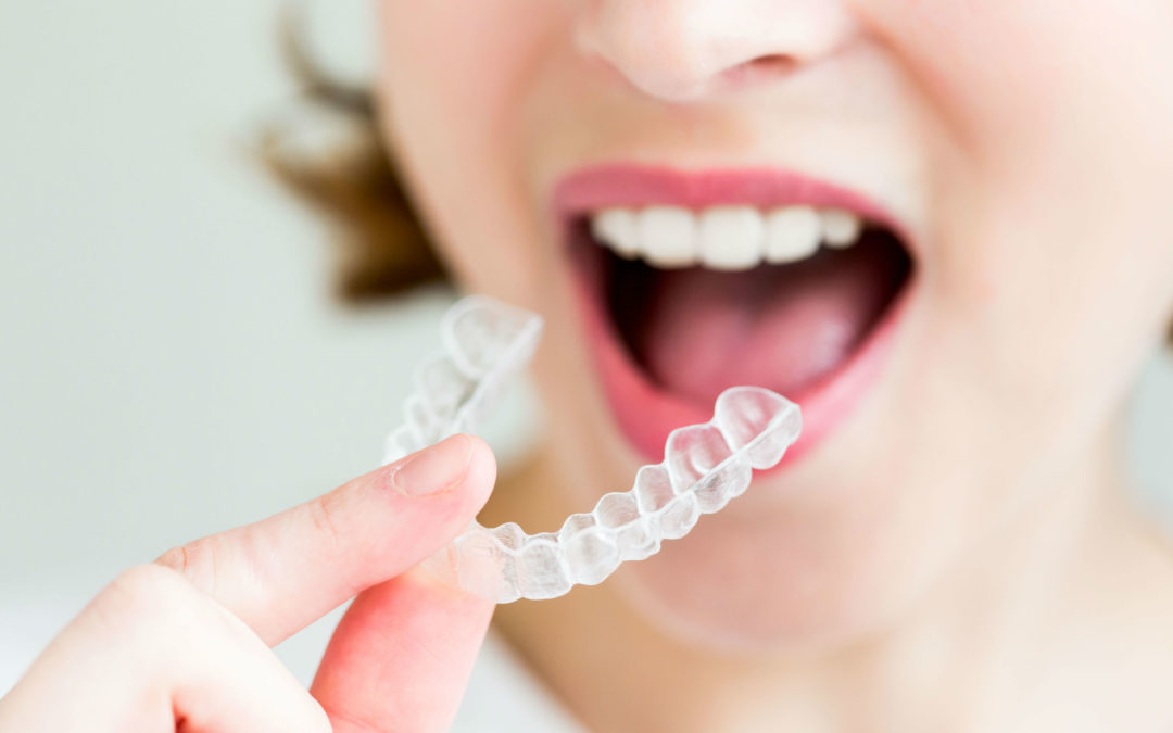 Ventajas de utilizar Invisalign en lugar de otros tratamientos de ortodoncia.