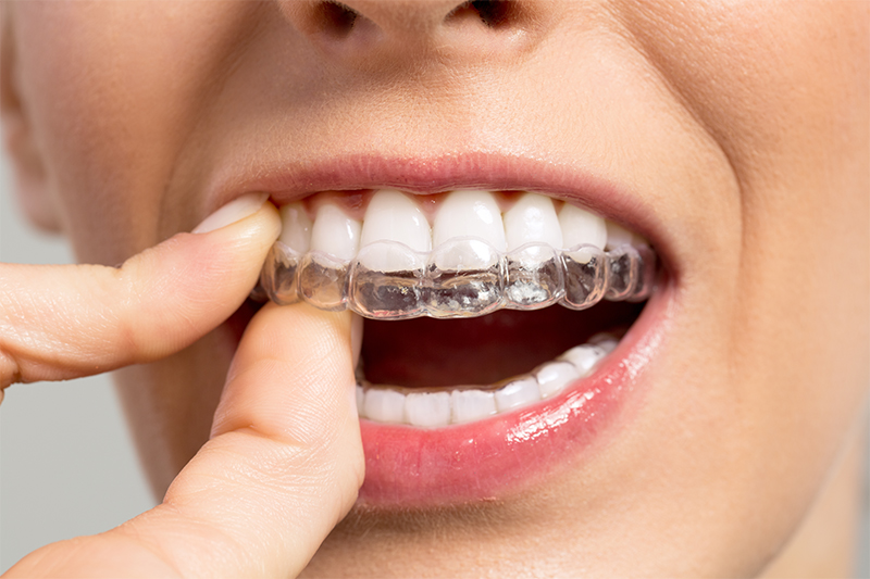 Realiza tu tratamiento de Invisalign en Barcelona Dental Center