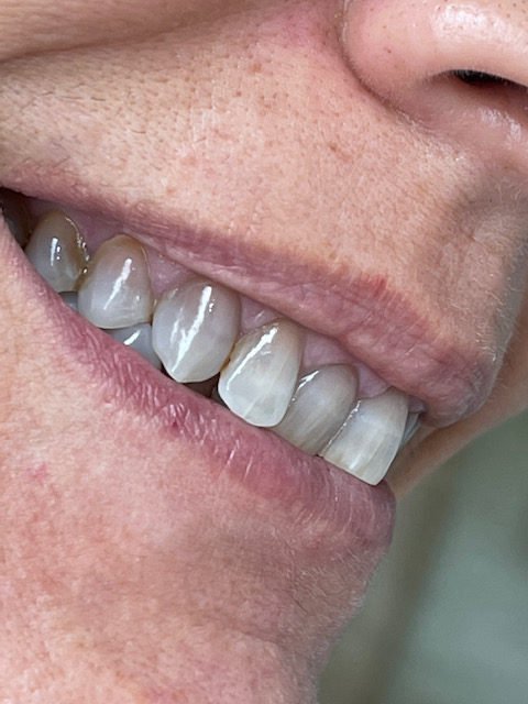 ortodoncia-invisalign-caso
