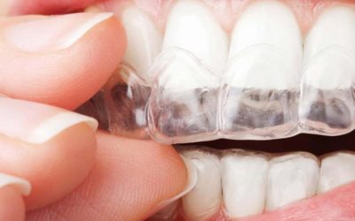 La ortodoncia invisible en Barcelona con las máximas garantías