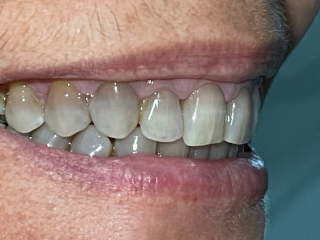 ortodoncia-invisible-caso-130-resultado