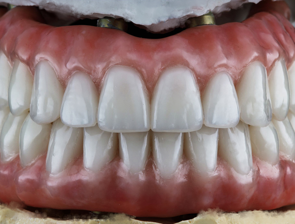 prótesis-dental-barcelona